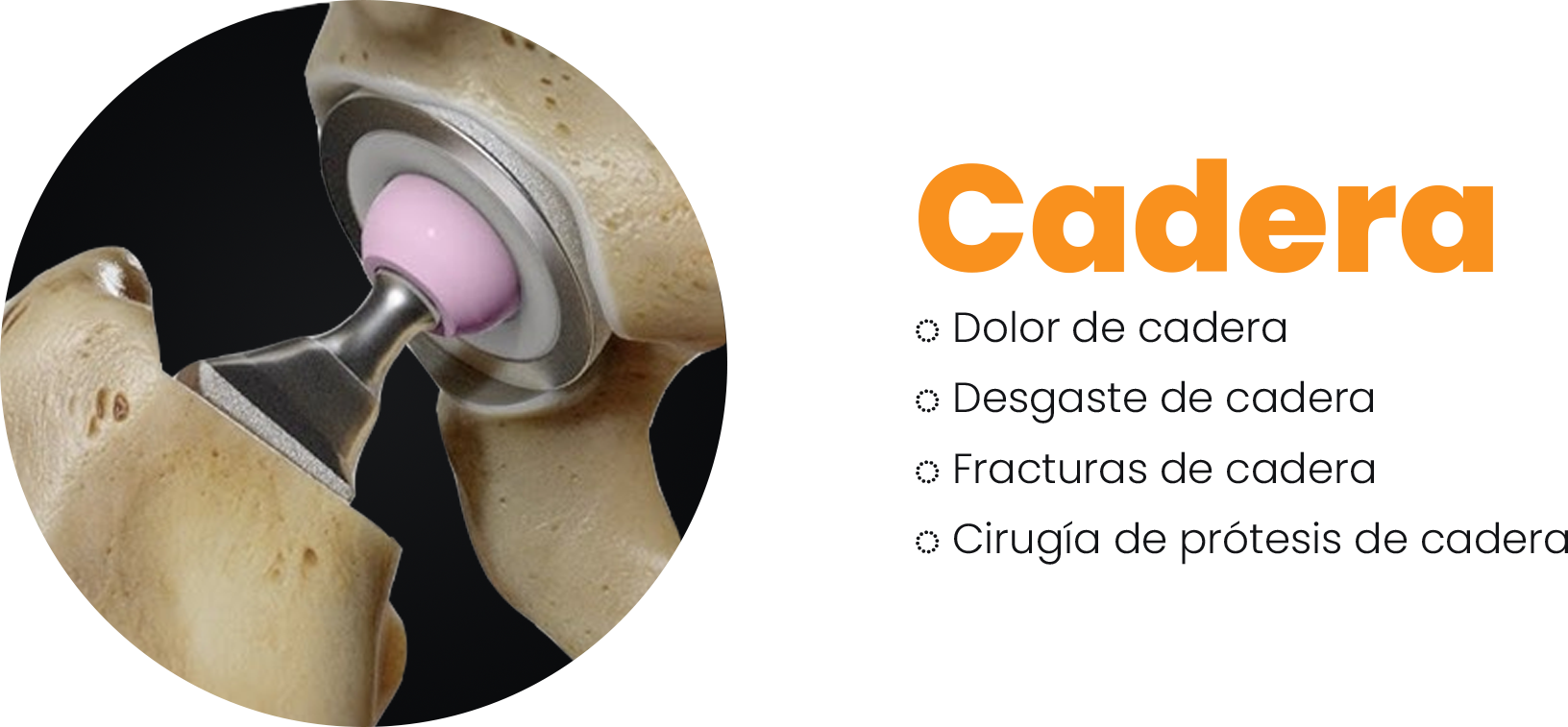 Cadera