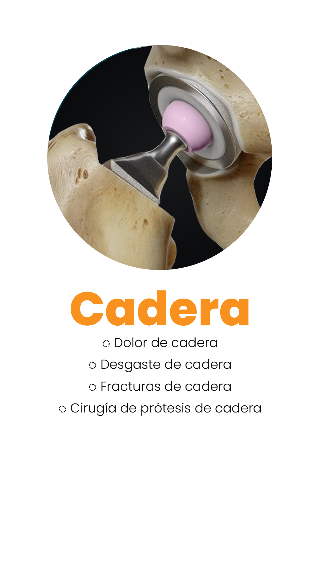 Cadera