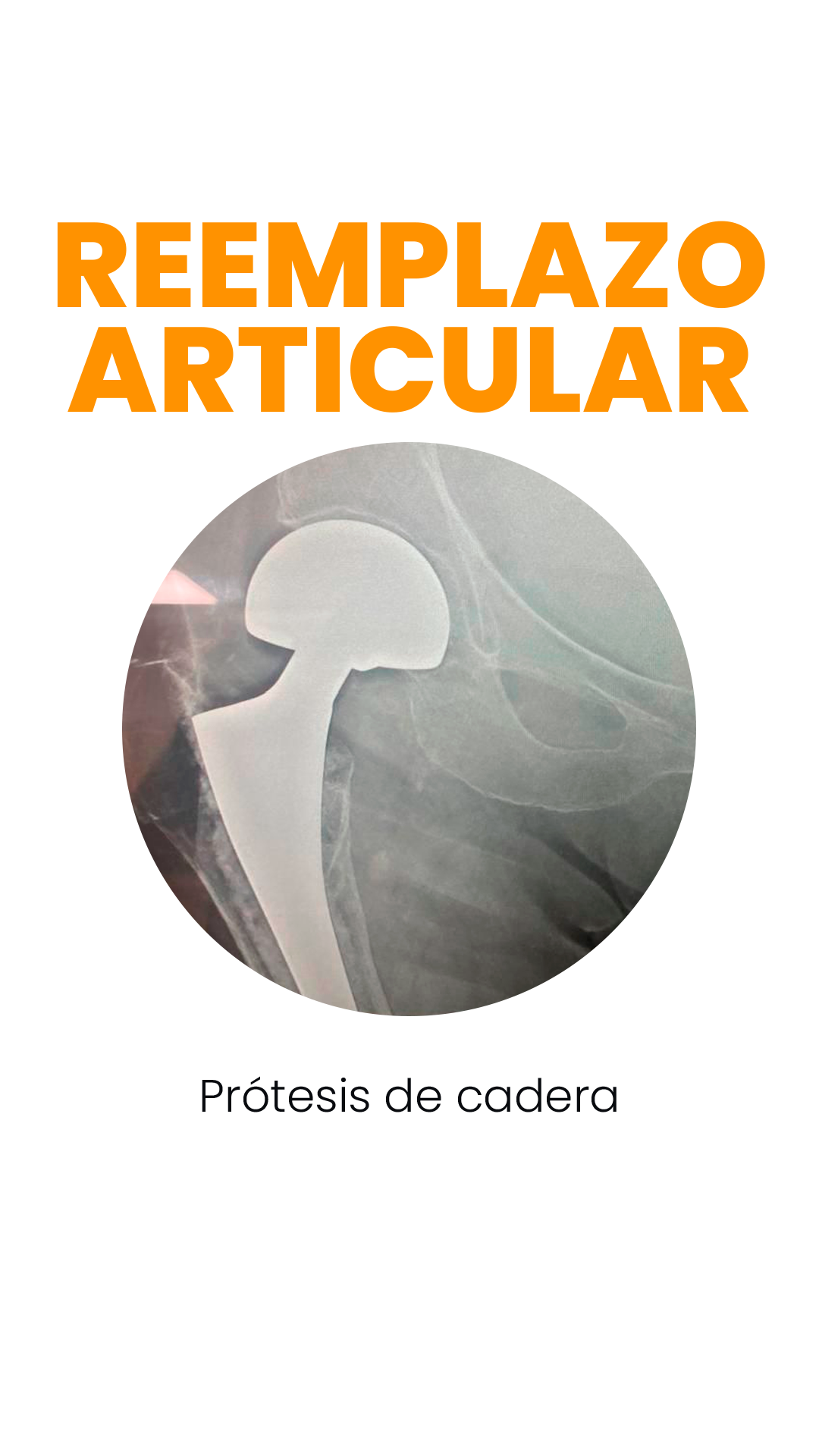 reemplazo articular